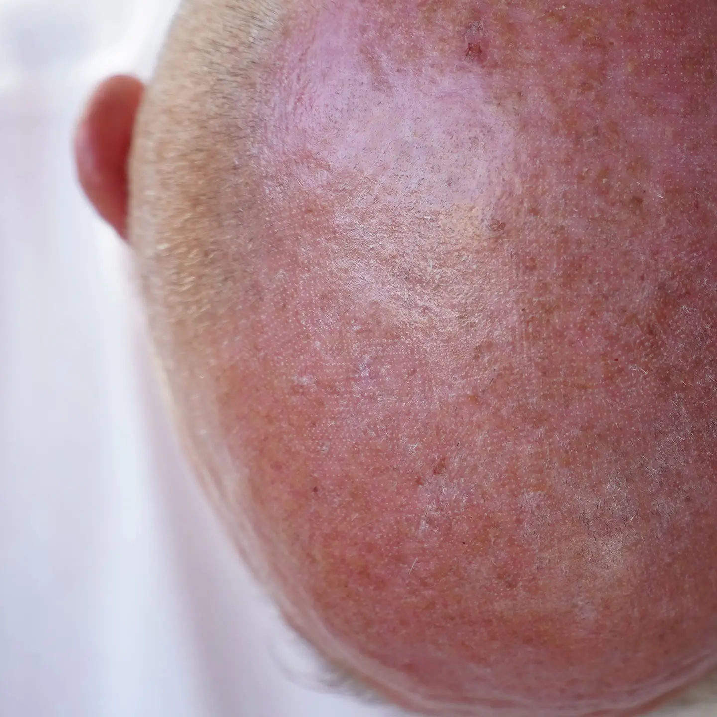 Actinic Keratoses