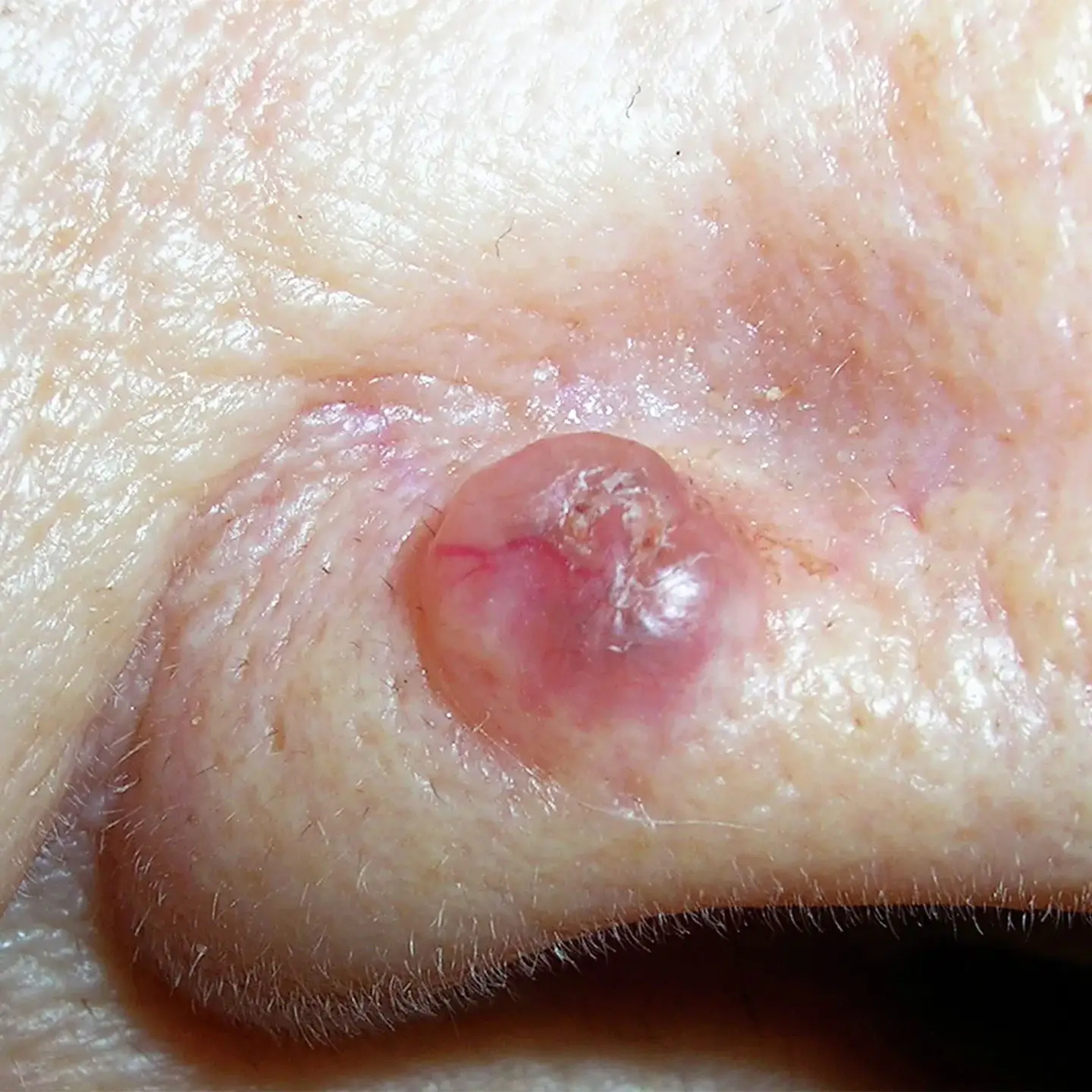 Basal Cell Carcinoma
