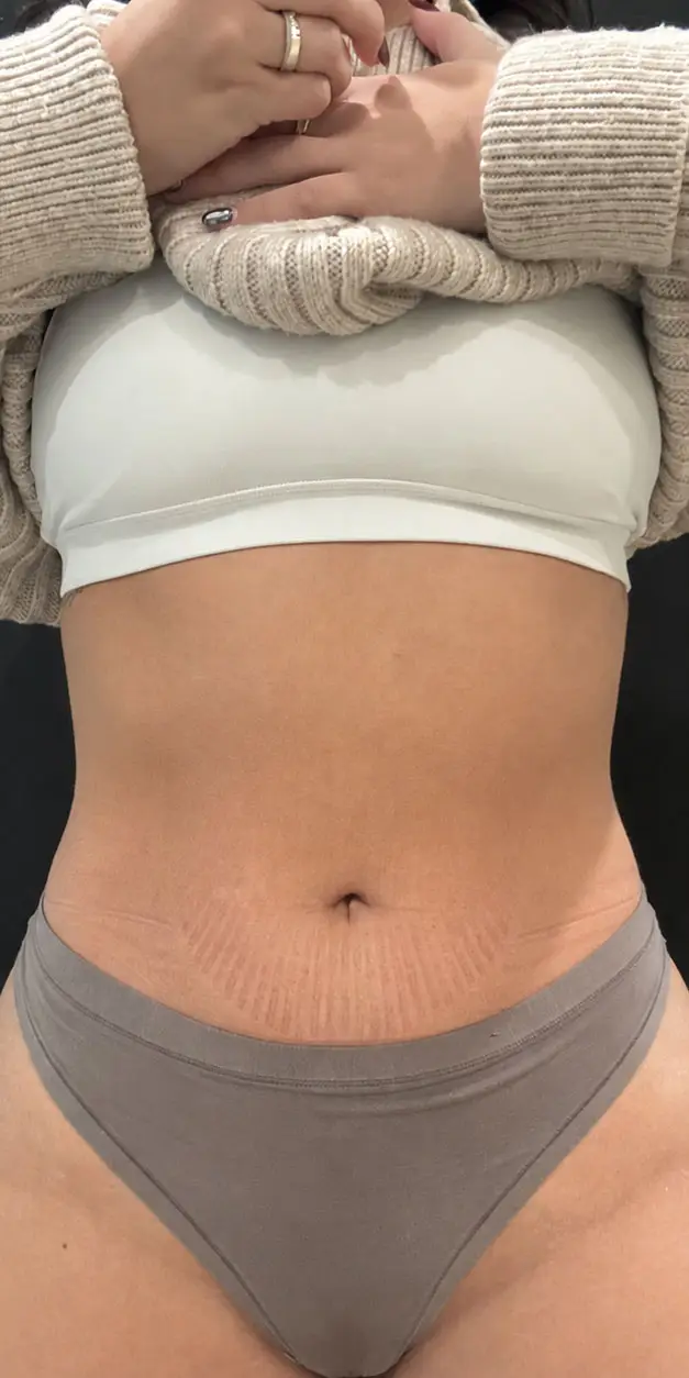 EvolveX Body Contouring