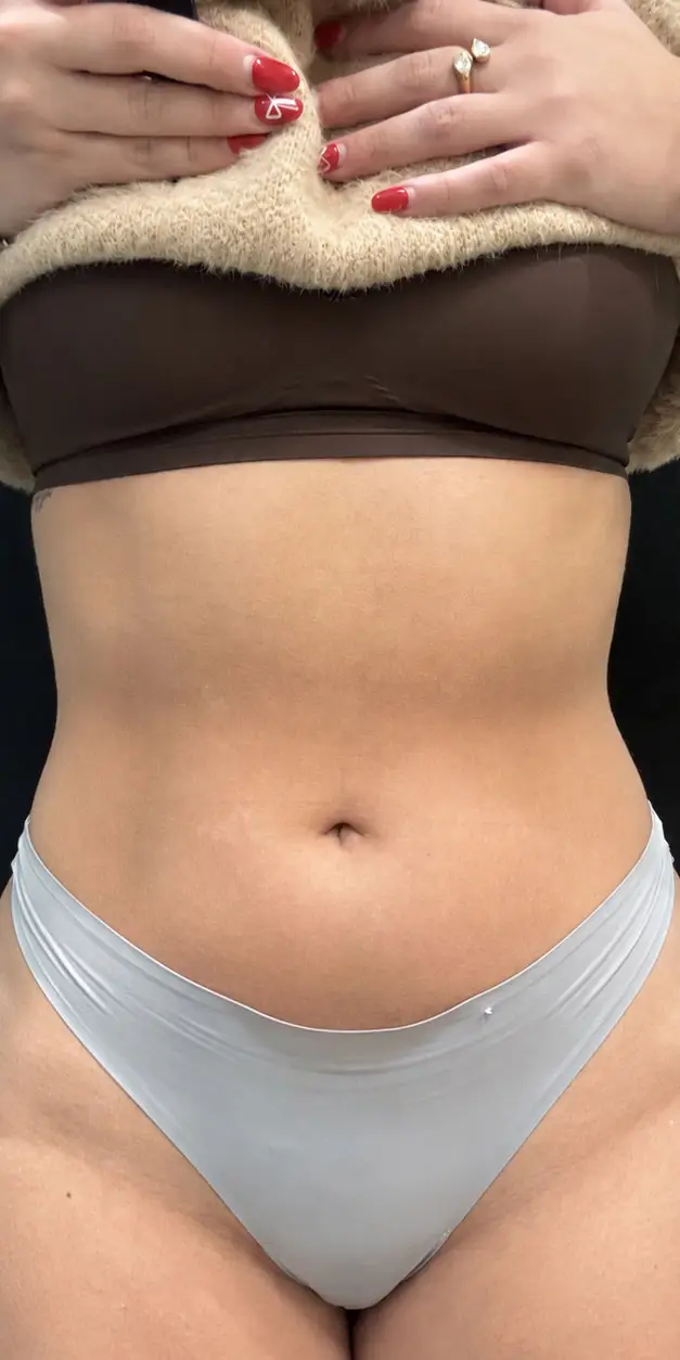 EvolveX Body Contouring