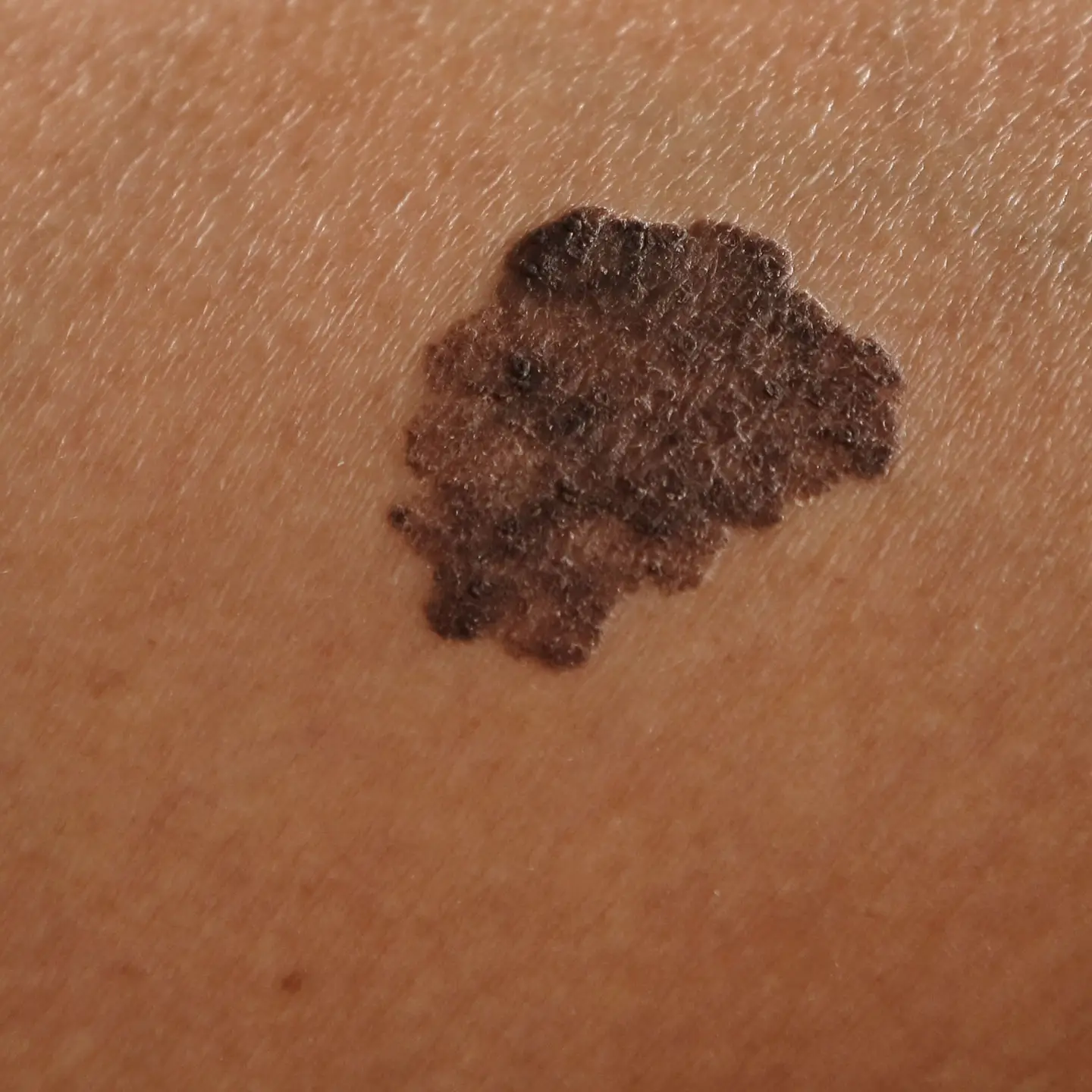 Melanoma