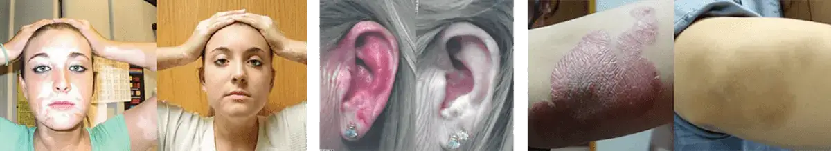 Pharos Excimer Laser Therapy