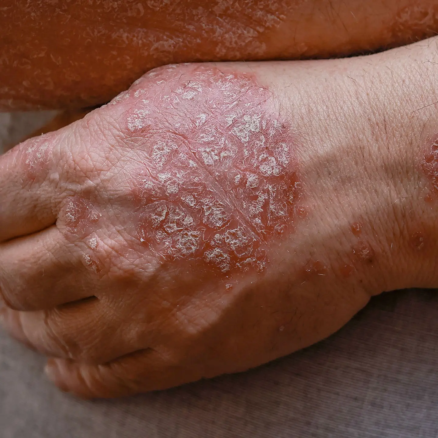 Psoriasis