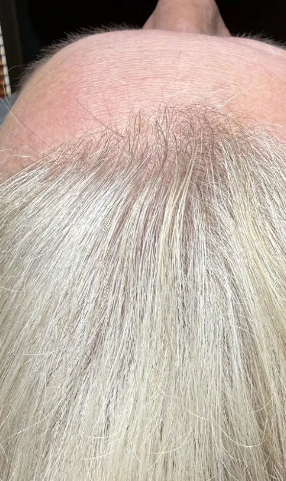 TED Hair Restoration