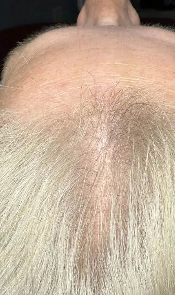 TED Hair Restoration