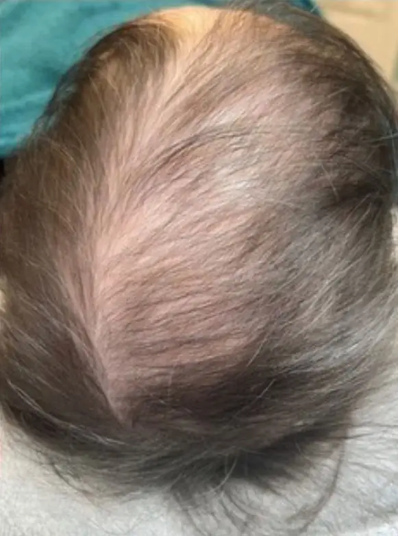TED Hair Restoration