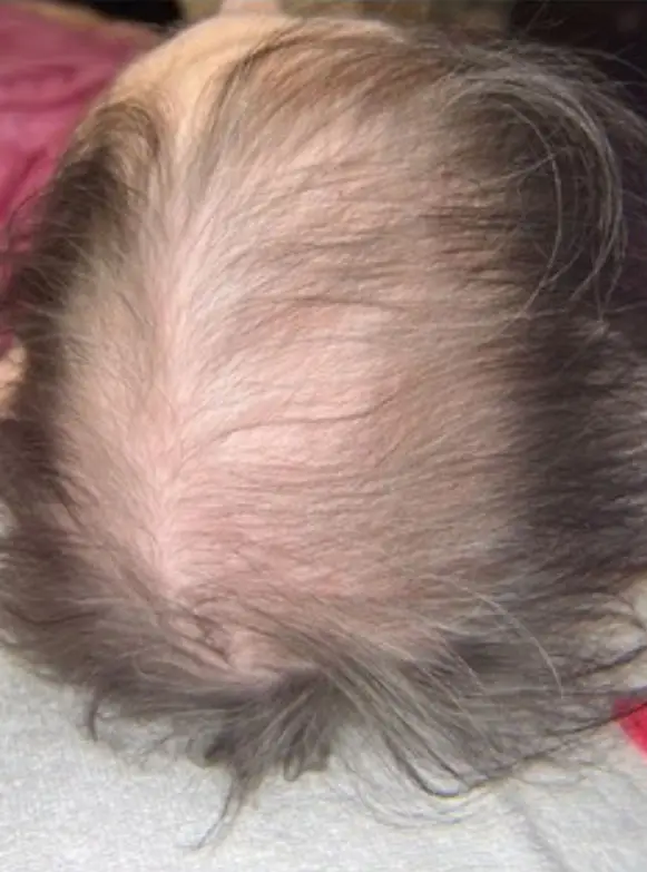 TED Hair Restoration