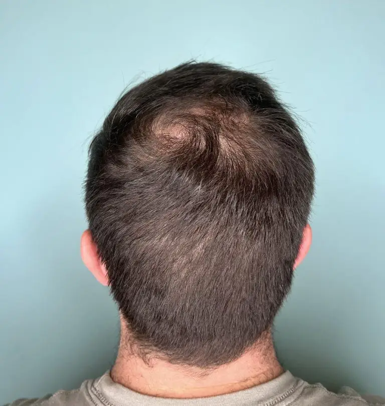 TED Hair Restoration