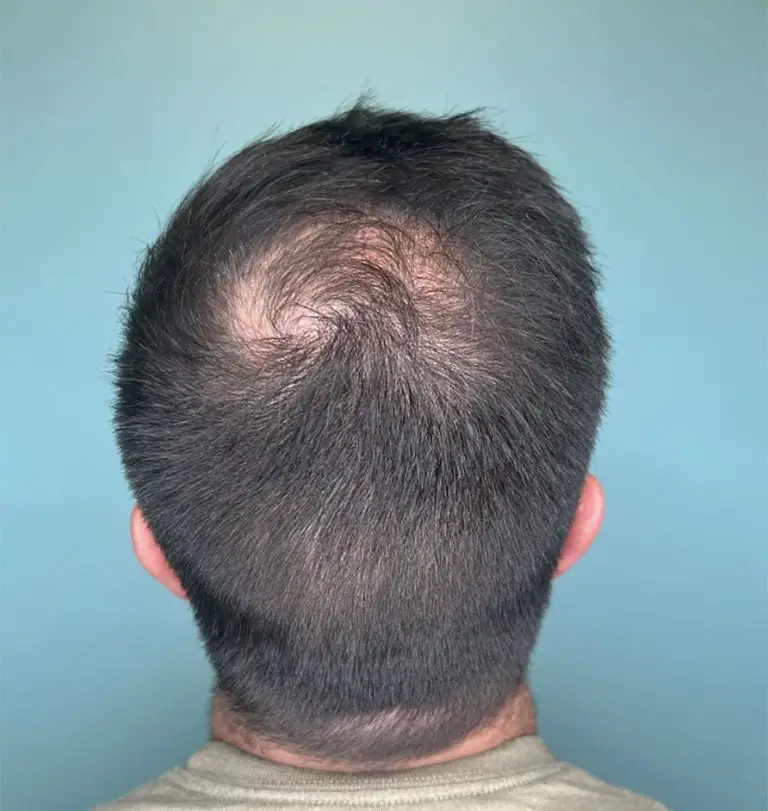 TED Hair Restoration