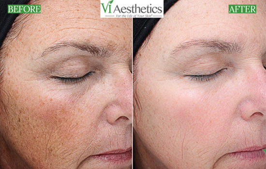 VI Precision Plus Peel