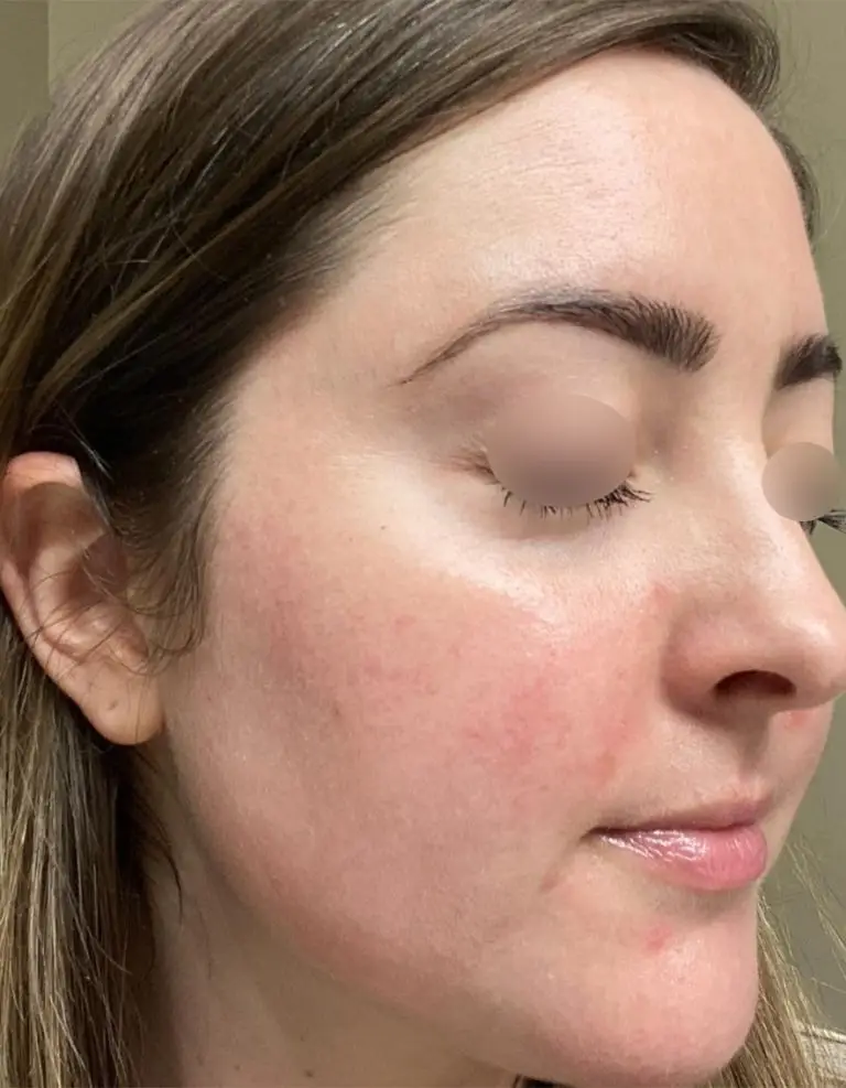 VI Peel Precision Plus & Purify (Chemical Peels)