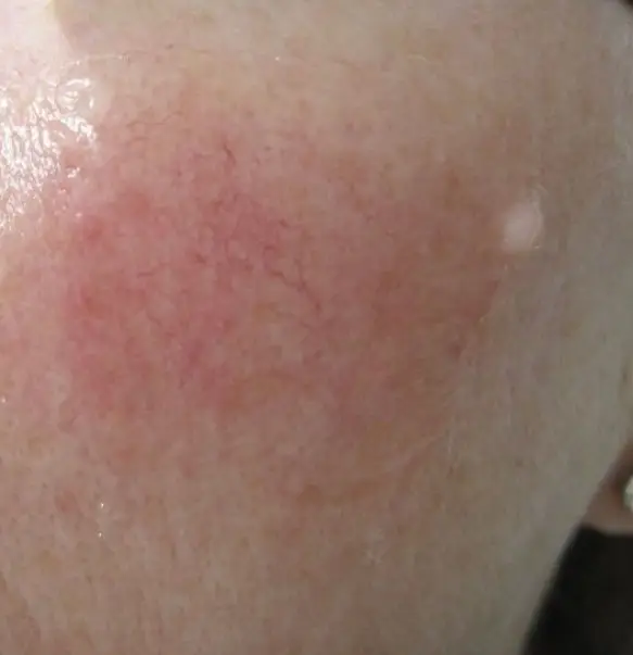 Vbeam (Pulsed-Dye) Laser