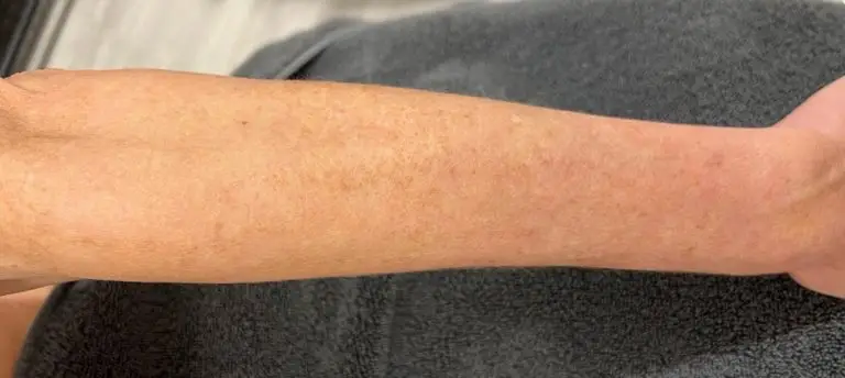 IPL (Intense Pulsed Light)