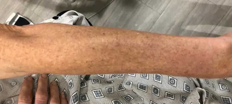 IPL (Intense Pulsed Light)