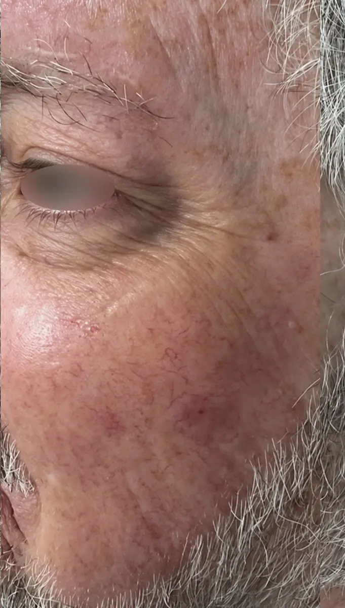 Laser Vein Removal