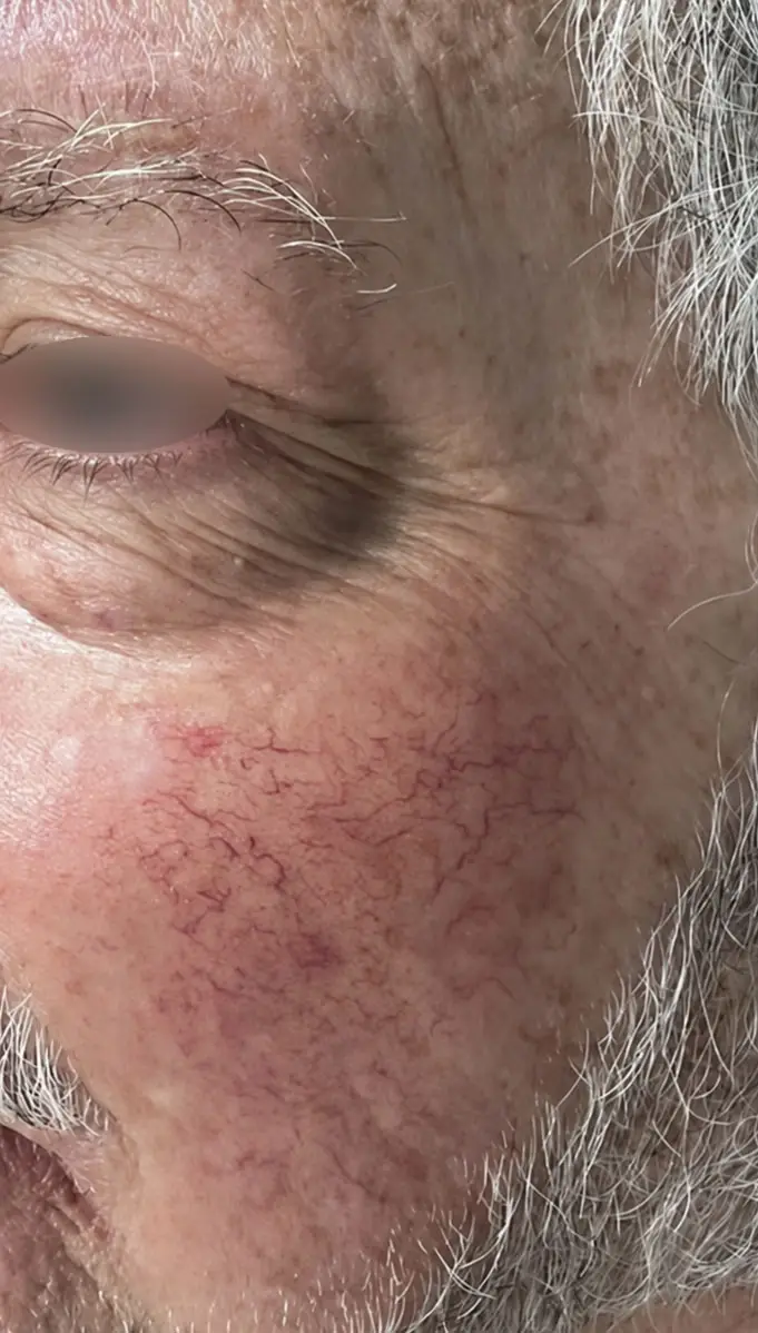 Laser Vein Removal