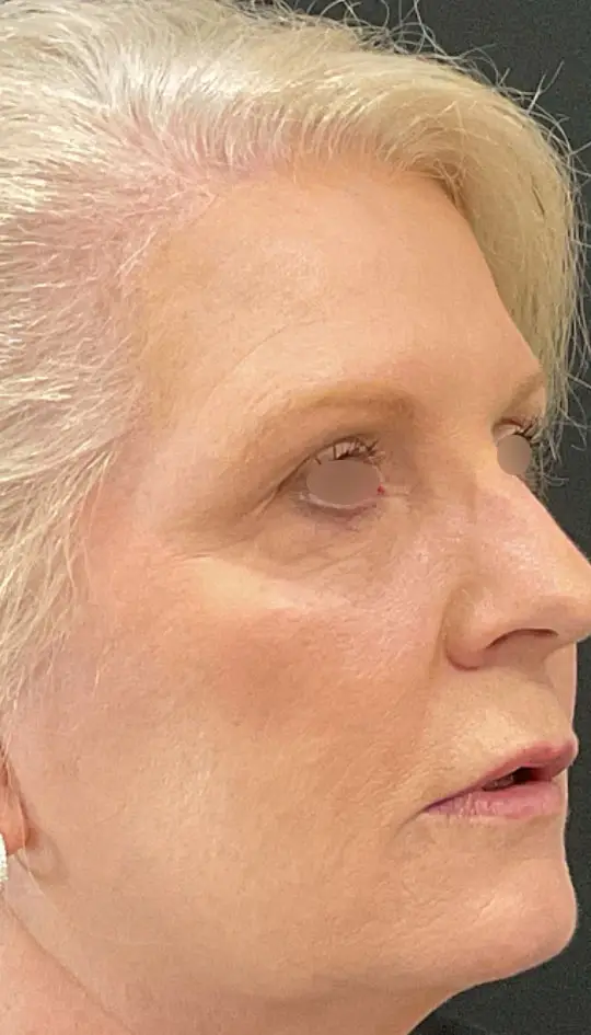 PRF (Platelet-Rich Fibrin) Undereye Injections