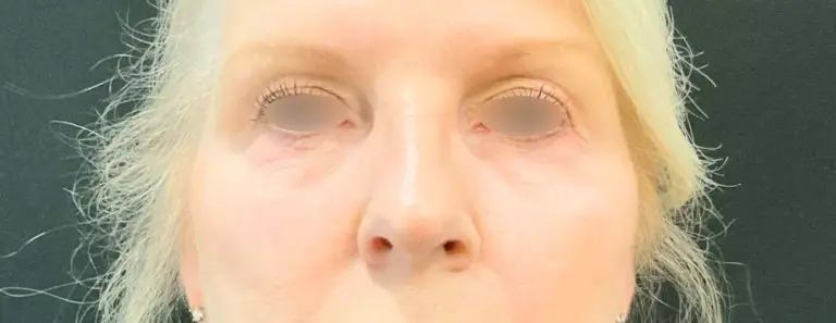 PRF (Platelet-Rich Fibrin) Undereye Injections