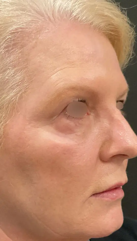PRF (Platelet-Rich Fibrin) Undereye Injections