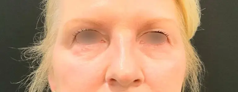 PRF (Platelet-Rich Fibrin) Undereye Injections