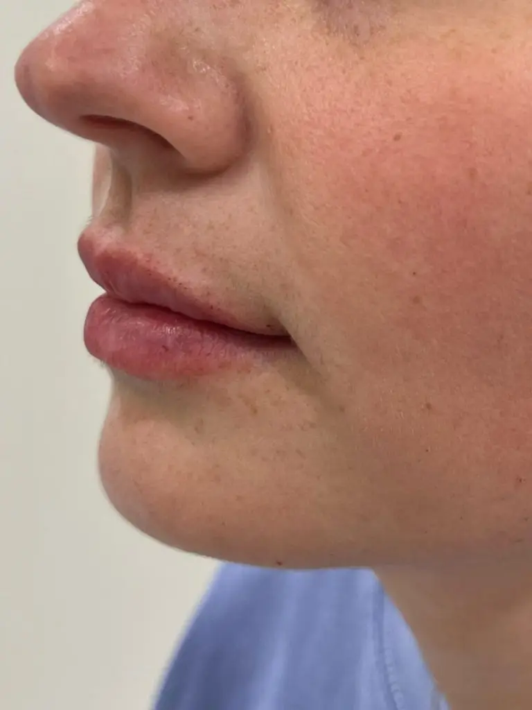 Lip Filler