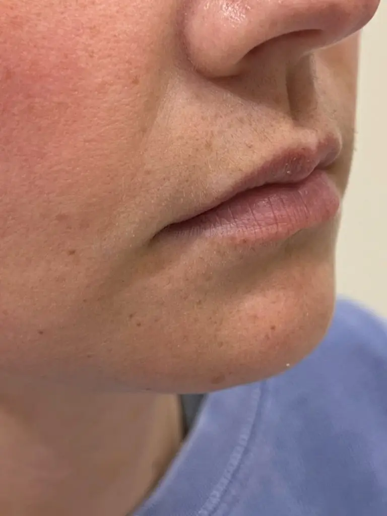 Lip Filler