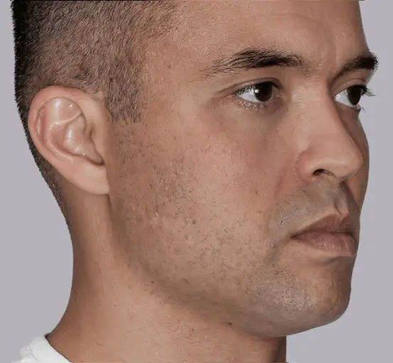 Sculptra