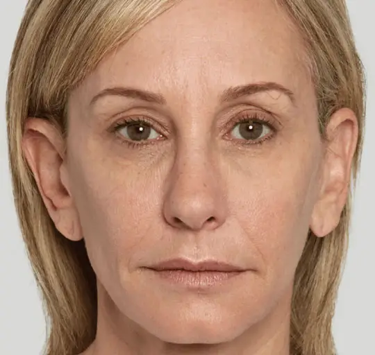 Sculptra