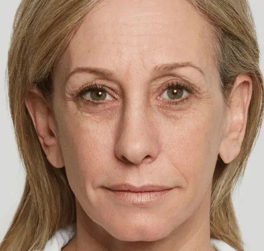 Sculptra