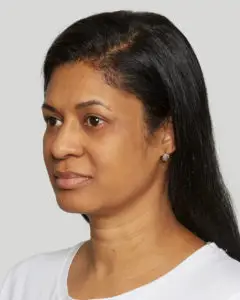 Sculptra Evelyn After