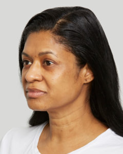 Sculptra Evelyn Before