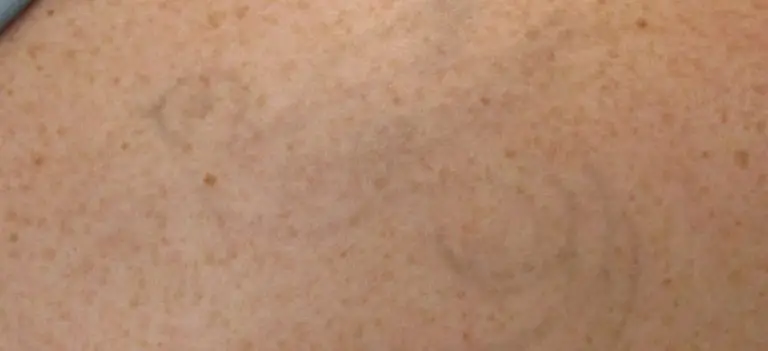 Laser Tattoo Removal