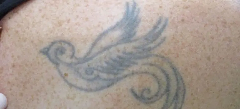 Laser Tattoo Removal