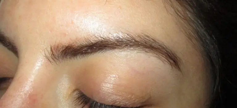 Laser Tattoo Removal