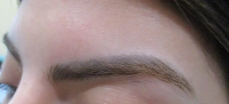Laser Tattoo Removal