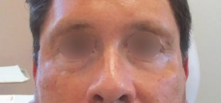 Undereye Filler